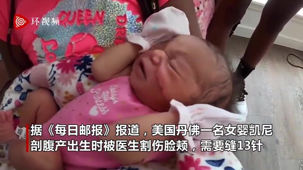 美国一女婴出生时被医生用手术刀割伤脸颊 需要缝13针