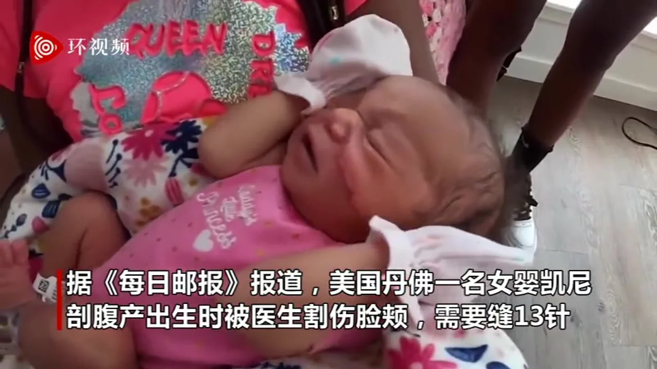 美国一女婴出生时被医生用手术刀割伤脸颊 需要缝13针