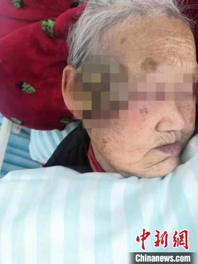 合肥96岁老人被肿瘤“吞”掉小半张脸 医生助其“换脸”