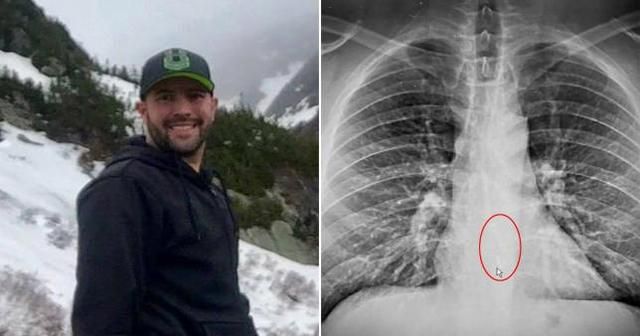 英国男子喝水难以下咽 拍片才知AirPod卡在食道